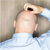 العلماء "يحلّون" لغز الإصابة بالصلع تمهيدا لعلاجه 